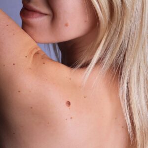 UV kokkupuute ja melanoomi seos on nõrk tumedama nahavärviga inimestel